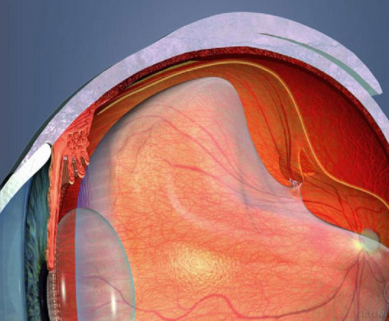 Roturas retinianas