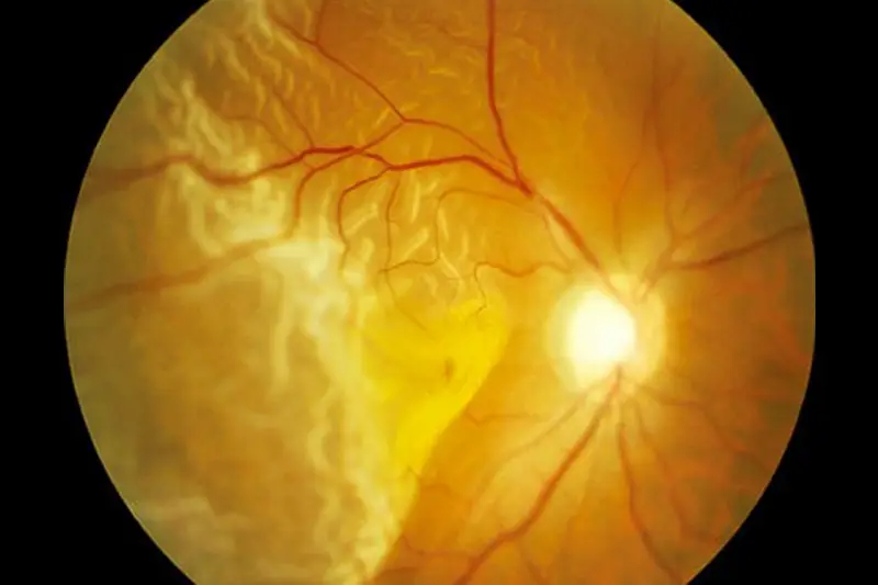 Cirurgias de Retina e Vítreo  Hospital de Olhos de Registro
